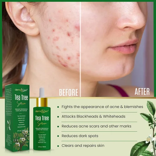 Vista 5 de Suero de árbol de té – Aceite de árbol de té orgánico con vitamina C natural para cicatrices de acné, manchas oscuras, granos e imperfecciones