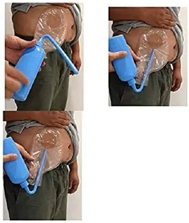 Vista 3 de Herramienta de limpieza de bolsas de colostomía, bolsa de estoma, olla de enjuague para todas las bolsas de ostomía, botella de lavado reutilizable
