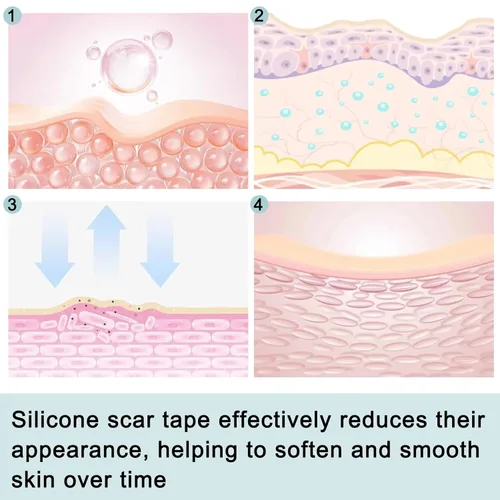 Vista 3 de Hojas de cicatrices de silicona para arrugas faciales, cicatrices - Tiras reutilizables para eliminar cicatrices, cinta de cicatriz